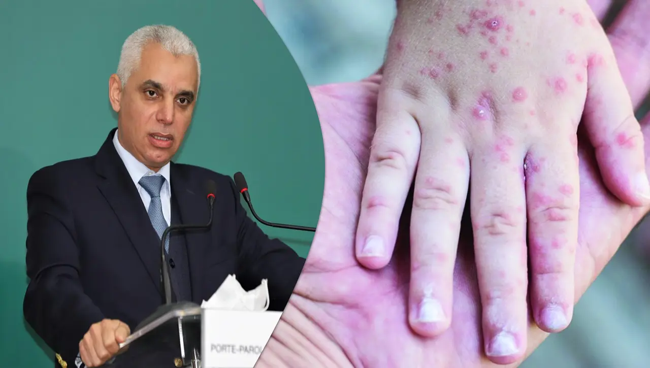 جدري القردة بالمغرب